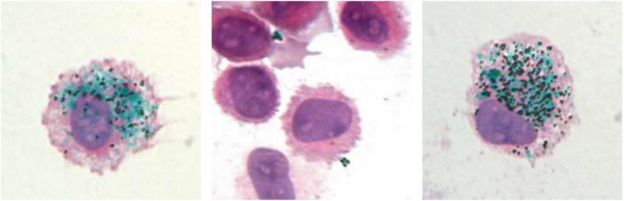Pigmento verde de uma tatuagem é visto dentro de um macrófago; no centro, o pigmento a liberado após a morte de uma célula; à direita, 90 dias depois, a tinta é recuperada por uma nova célula