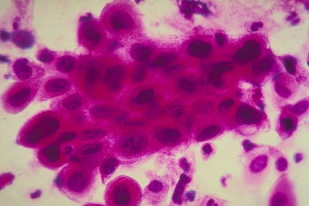 La prueba del Papanicolaou puede detectar las céculas precancerígenas antes de que se desarrolle la enfermedad.