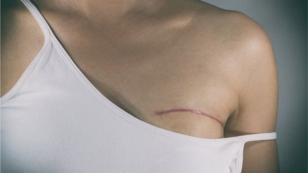 Imagem mostra mulher com cicatriz no seio, em referência ao câncer de mama