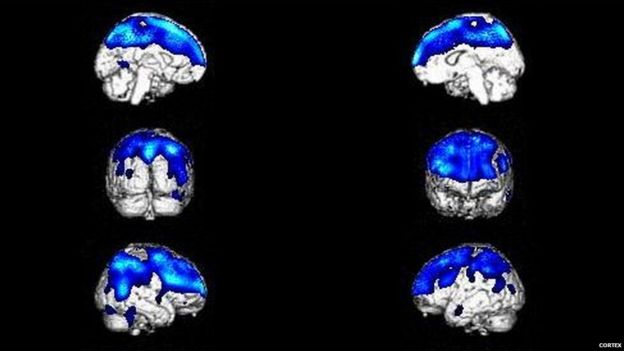 Imágenes cerebrales de un paciente con el síndrome de Cotard. (Foto: Cortex)