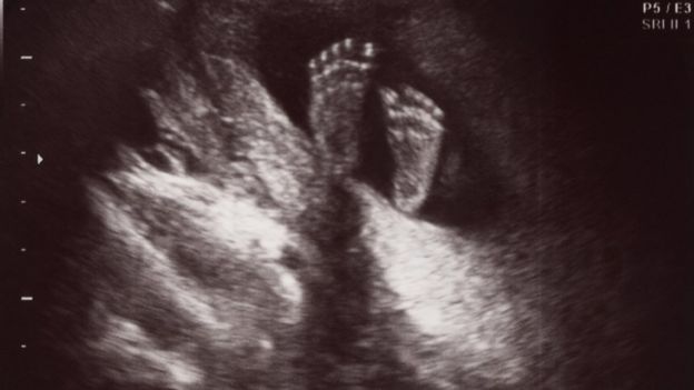 ecografía que muestra los pies de un bebé no nacido.