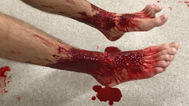 Primer plano de las lesiones en las piernas de Sam Kanizay