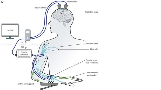 Restoration of reaching and grasping movements through brain-controlled muscle stimulation in a person with tetraplegia: a proof-of-concept demonstration