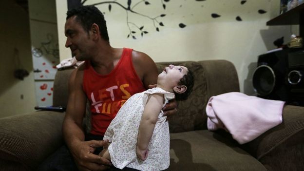 Homem com filha com microcefalia no colo