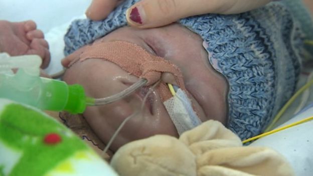 New Heart for Eight-week-old Charlie Douthwaite New Heart for Eight-week-old Charlie Douthwaite