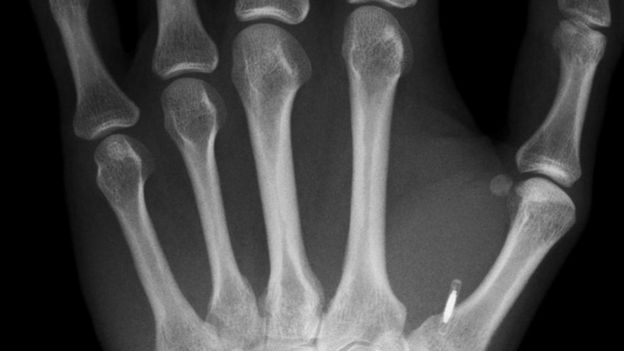 Una imagen de rayos X de una mano con un pequeño microchip implantado
