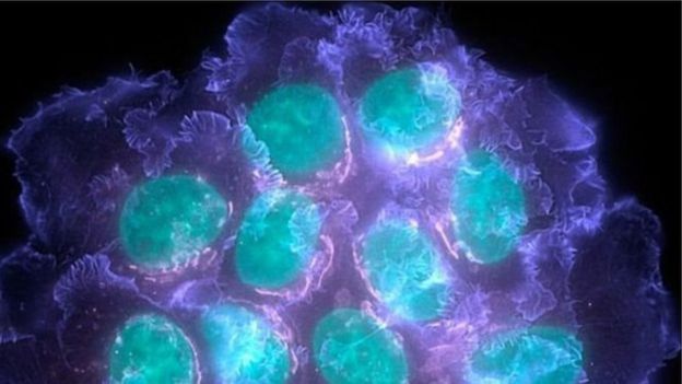 புற்றுநோய்