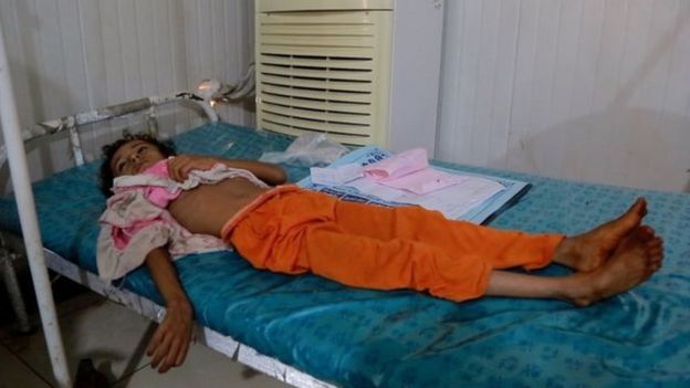 کمبود غذا بسیاری از کودکان یمنی را در مقابل خطر ابتلا به وبا آسیب‌پذیر کرده است