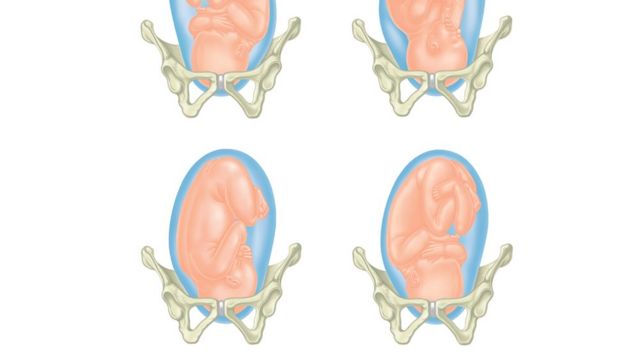 Ilustração com 4 visões de feto encaixado na pelvis