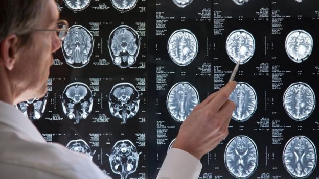 طبيب يشير إلى صور آشعة مختلفة للدماغ