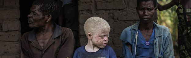 An albino child in Malawi sits between his parents
