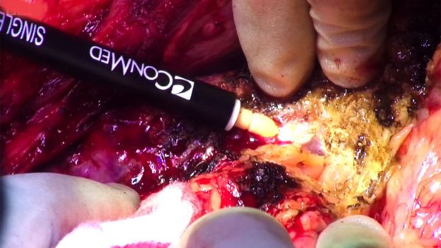 Con un lápiz electroquirúrgico empieza a separar el hígado del tejido circundante.