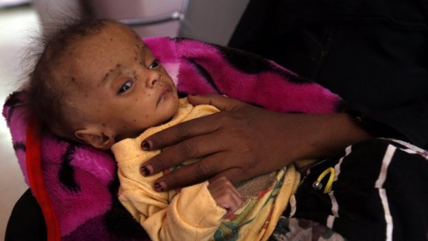 A Yemeni woman holds her malnourished child receiving treatment amid worsening malnutrition at a hospital in Sana