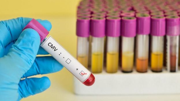 Exame sorológico de CMV