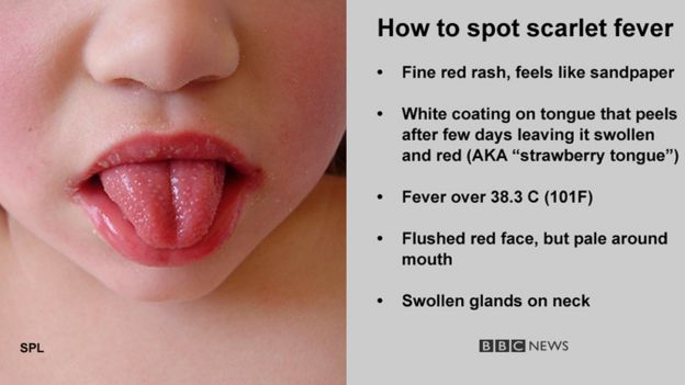 Symptoms of scarlet fever