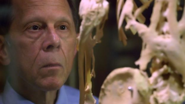 Dr. Kaplan observando o esqueleto de Harry Eastlack