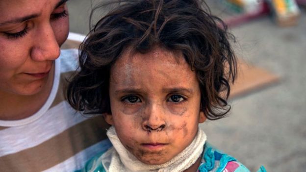 Menina ferida em Mossul