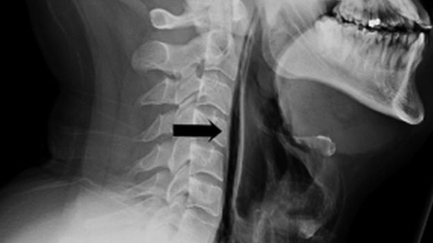 Radiografía del cuello del hombre que se rasgó la garganta por reprimir un estornudo.