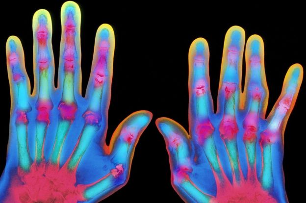 _90886805_m1100383-coloured_x-ray_of_hands_with_rheumatoid_arthritis-spl.jpg