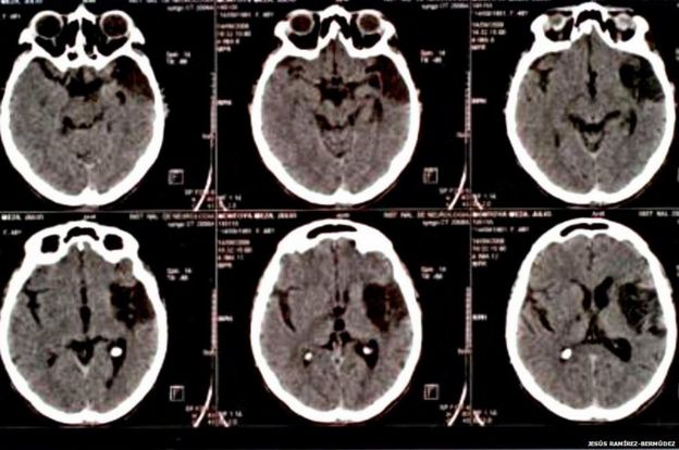 Daño cerebral en un paciente con síndrome de Cotard (Foto: Jesus Bermudez-Ramirez)