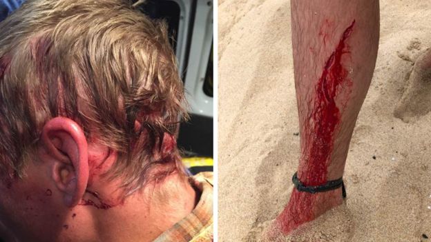 Ferimentos em Dylan McWilliam após ataques de urso e tubarão