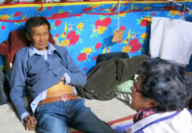 Timurbat, paciente de Mongolia con cáncer de hígado.