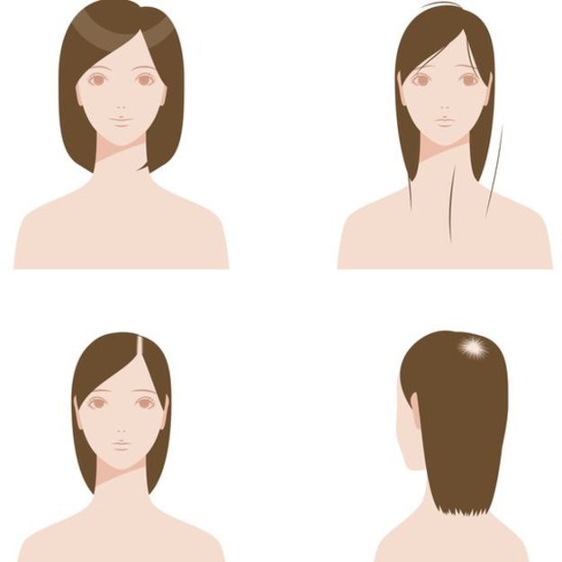 Desenho ilustra áreas mais comuns de falta de cabelo em mulheres