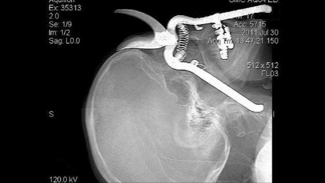 X-ray of Leroy Luetscher's eye injury