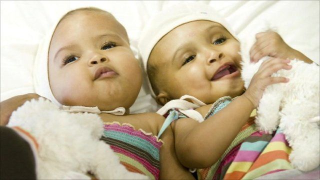 The twins after their separation