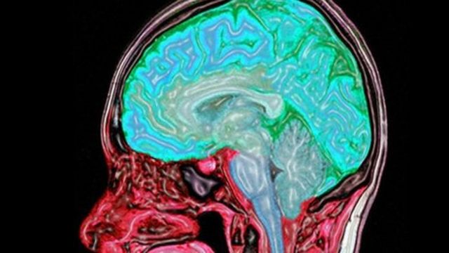 Picture of a brain scan