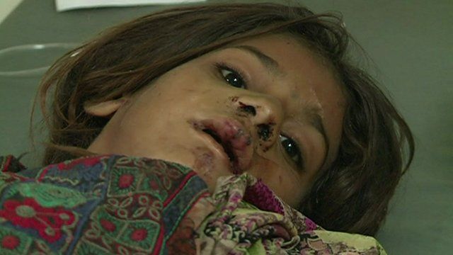 Injured girl