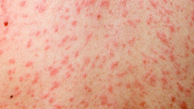 Measles rash
