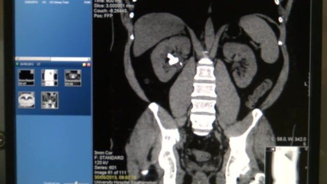 A scan with the kidney stone visible