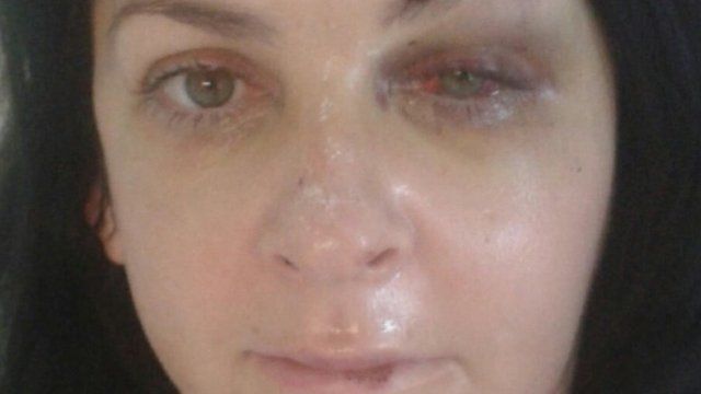 Morag Fisher broke her cheek, wrists, eye socket and injured her back in the fall