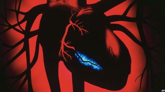 heart attack