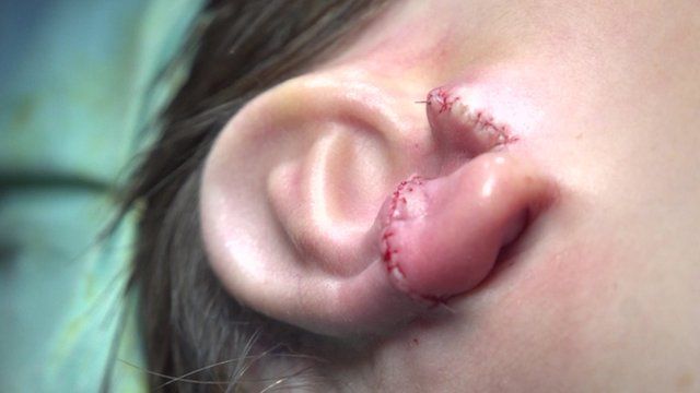 Nine-year-old Kieran Sorkin had the surgery at London's Great Ormond Street Hospital.