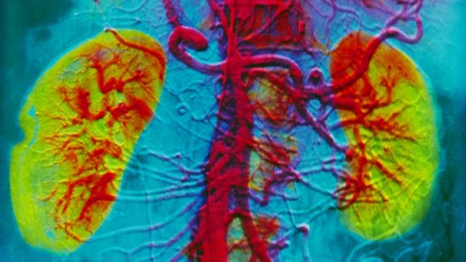 Angiogram of human kidneys