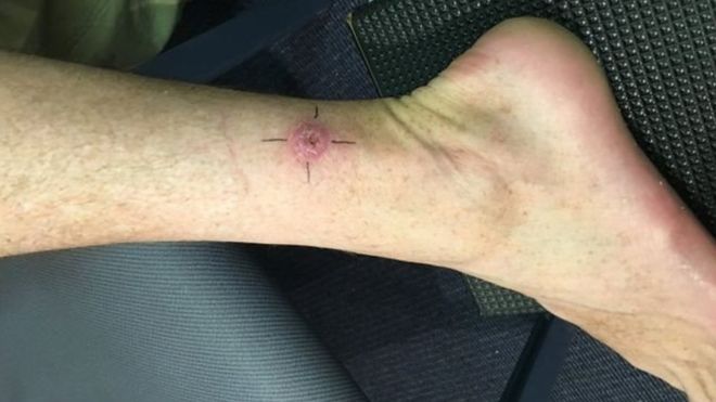 Una herida en una pierna