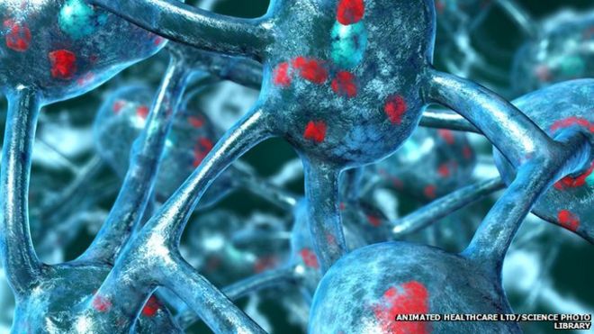 Parkinson's disease: computer artwork of neurones