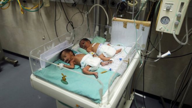 الأوبزرفر: خلافات الفلسطينيين تفاقم معاناة الأطفال في مستشفى غزة