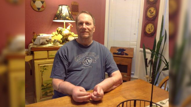 'Queria voltar a usar próteses': o arrependimento do 1º americano a receber transplante duplo de mãos