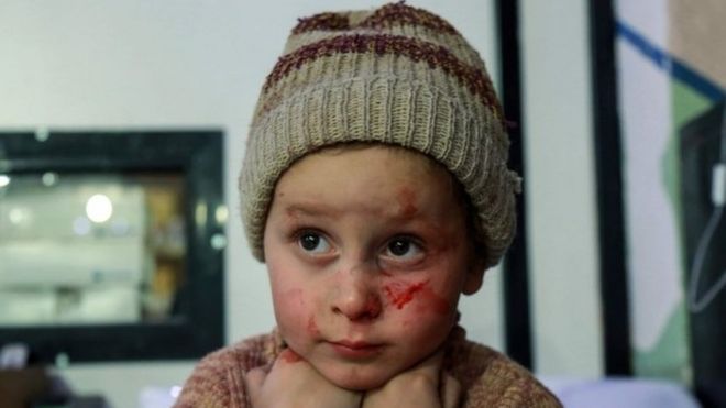 Uma criança Síria na região de Ghouta com manchas de sangue sa batalha, em 3 de março de 2018