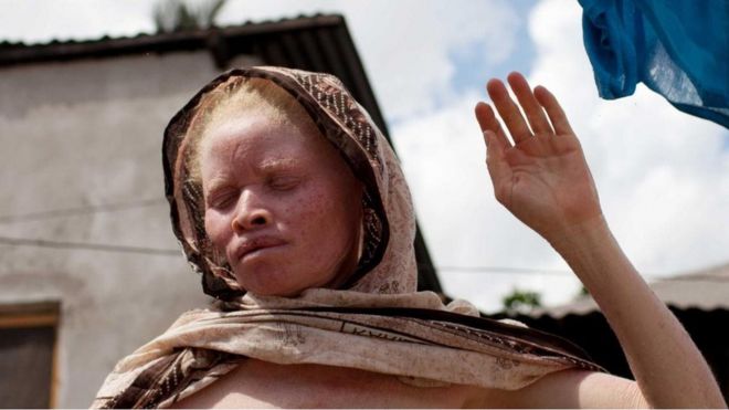 "القاتل الصامت" لمرضى المهق في أفريقيا