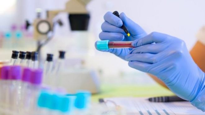 اختبار دم جديد "يساعد في تحديد العلاج الفعال" لسرطان البروستاتا