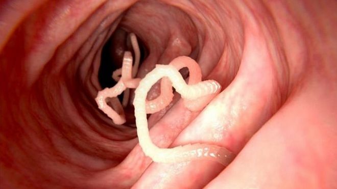 Parásitos en un intestino