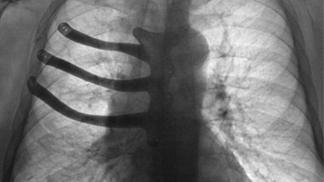 Рентгеновский снимок груди Питера Меггса с имплантатом