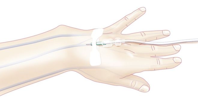 Illustration of a catheter being inserted into a vein in the hand for a general anaesthetic or the injection of various substances