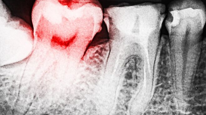Inflamed tooth
