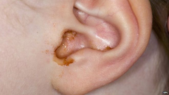 excess ear wax