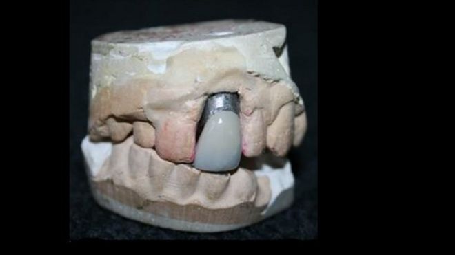 Dental mould and crown